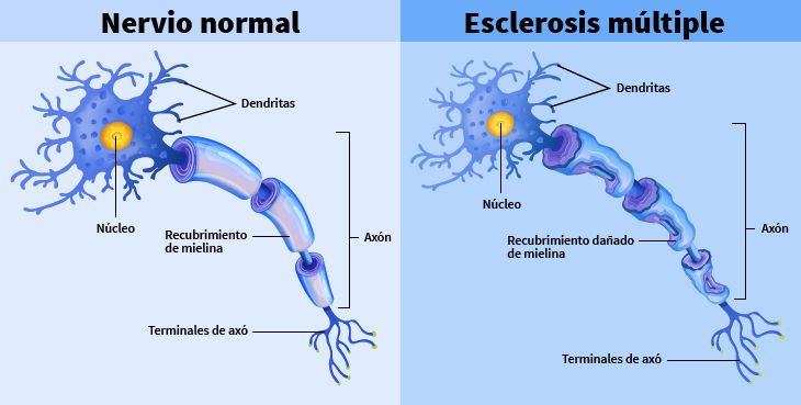 En un nervio normal, la capa no está dañada. Aquí, parte de la capa o recubrimiento parece estar corroída.